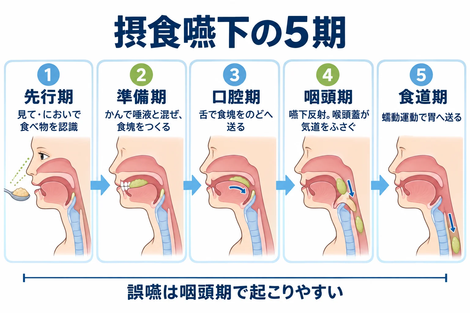 摂食嚥下の5期を、先行期・準備期・口腔期・咽頭期・食道期の順に横顔の断面で示した図。咽頭期は嚥下反射で喉頭蓋が気道をふさぐ。誤嚥は咽頭期で起こりやすい。